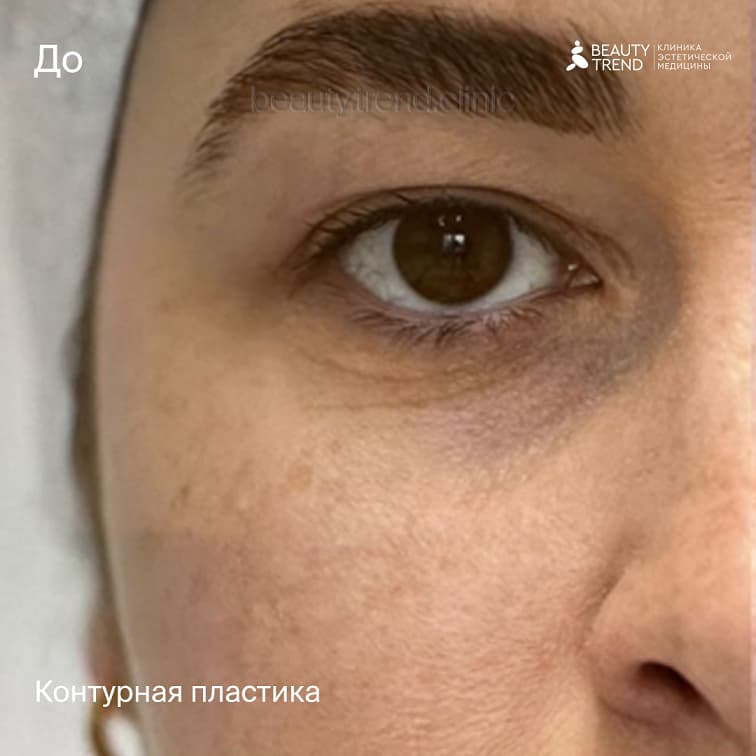 Коррекция носослезной борозды - до 1